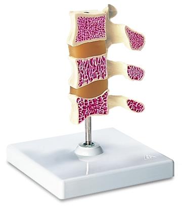 Osteoporose 3 stadia