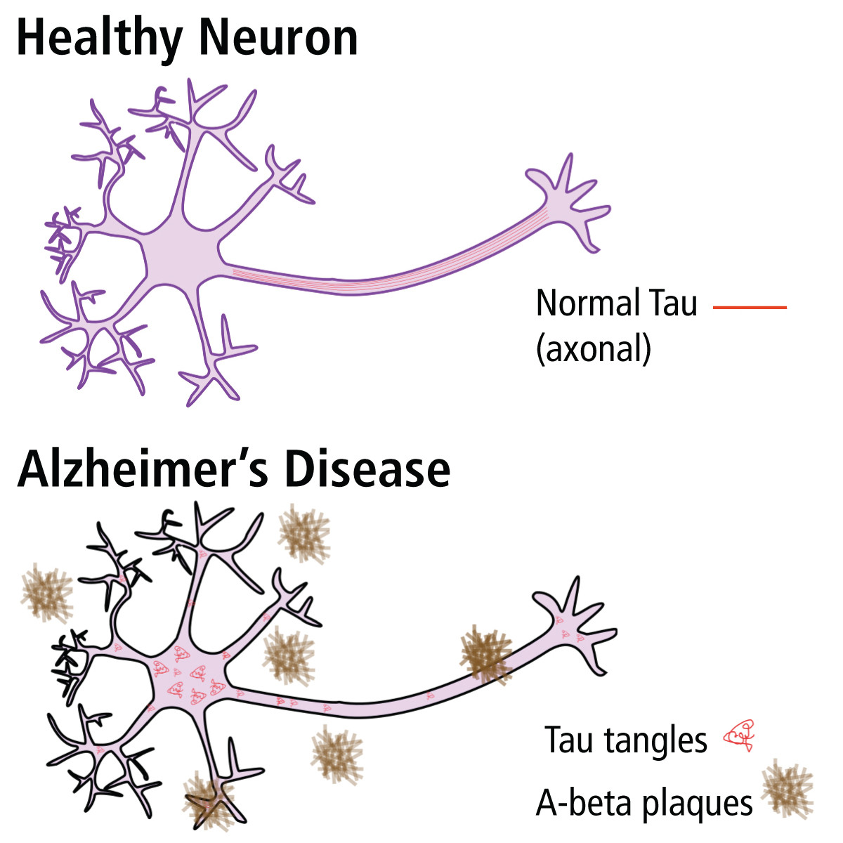 Alzheimer aantonen met ELISA