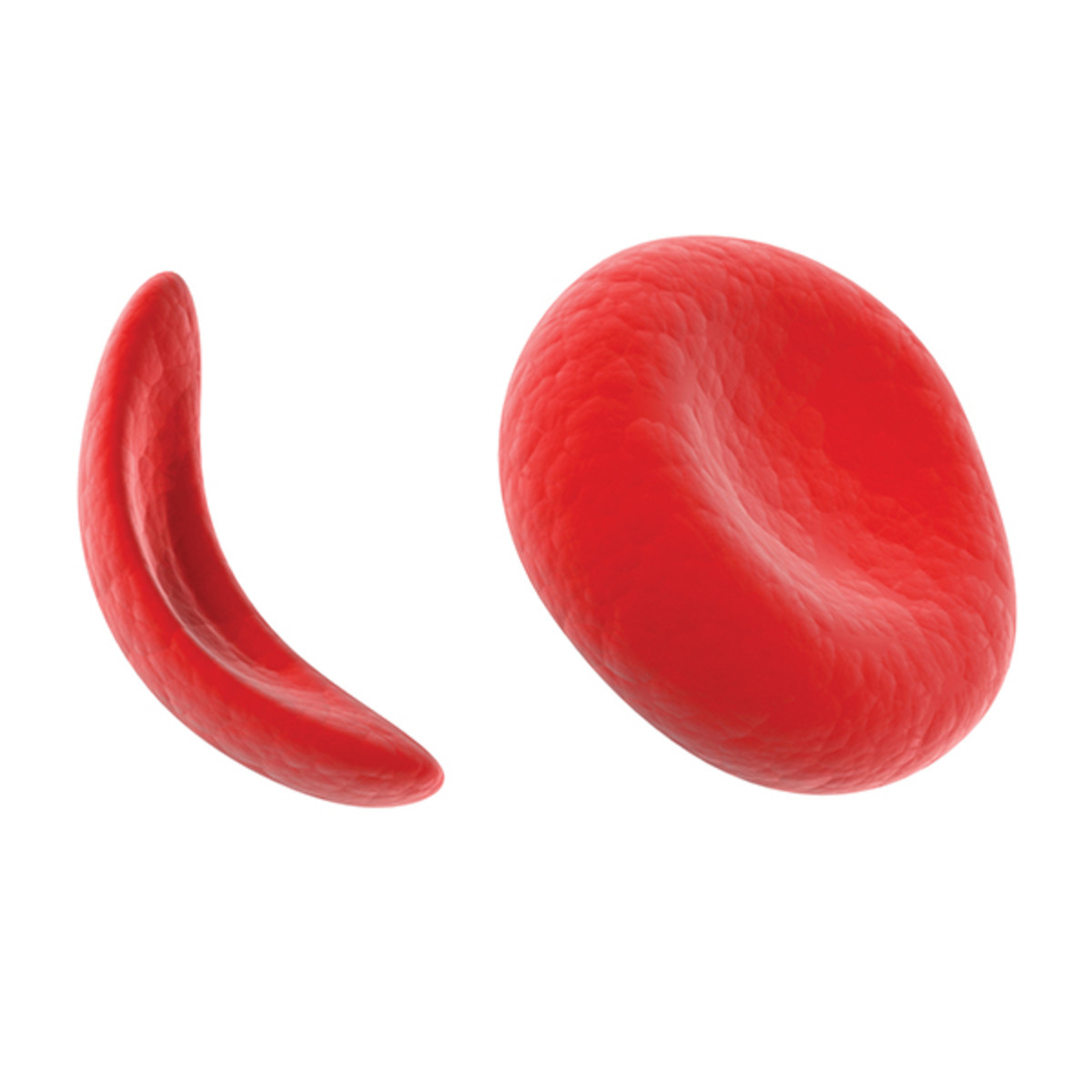 Sickle Cell Gene Detection (DNA-based)