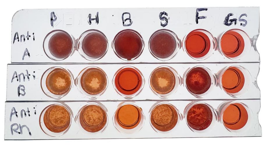Bloedtypering voor Stamcel transplantati