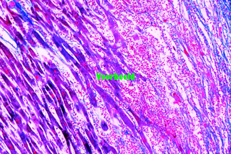 Myocarditis chronica acute recidivans