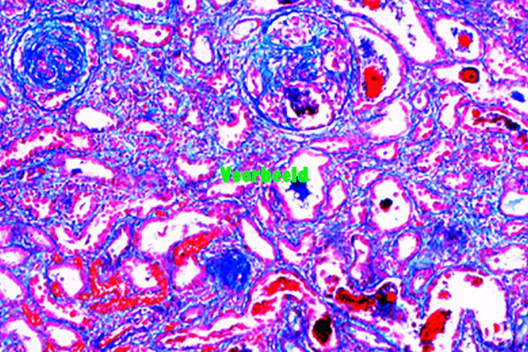 Chronic glomerulonephritis