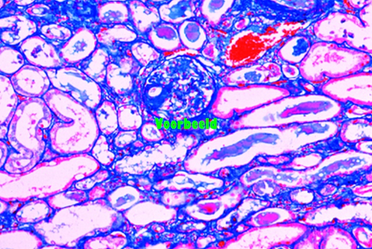 Amyloid degeneration of kidney