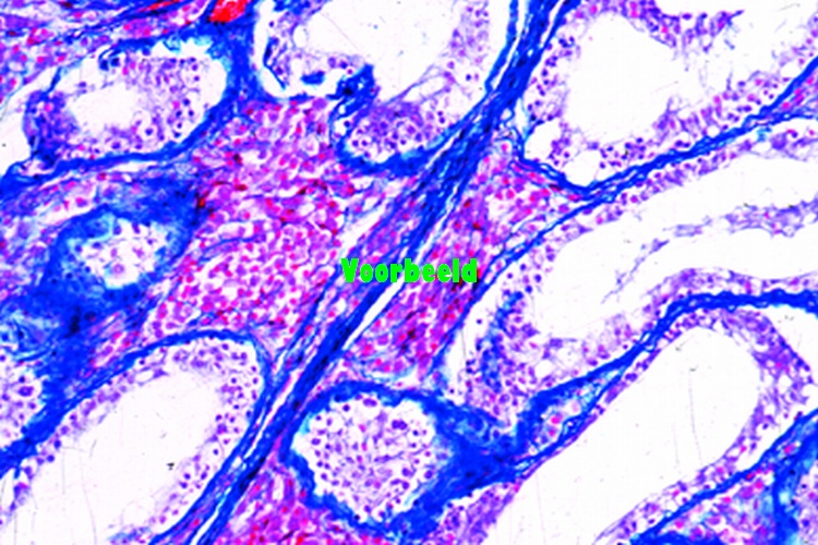 Carcinoma cervicis uteri