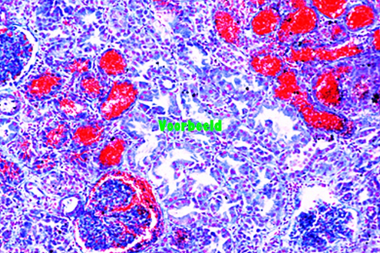 Acute hemorrhagic nephritis