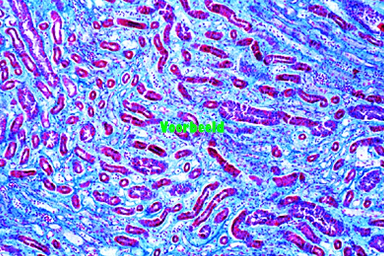 Glycogenosis of kidney