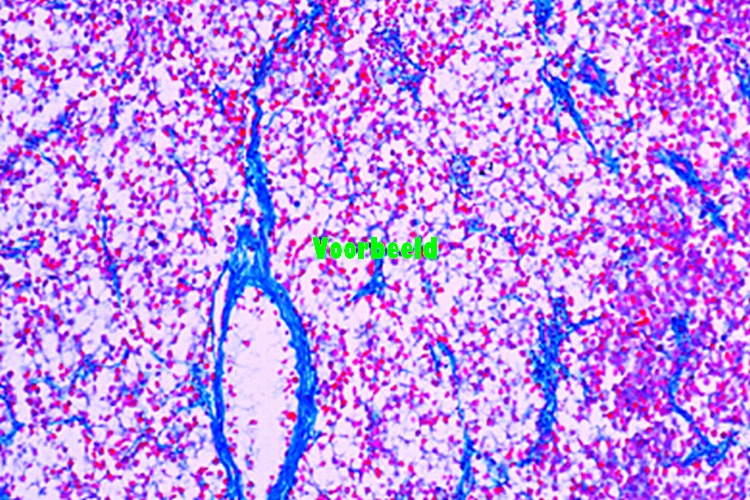 Sarcoma of testicle