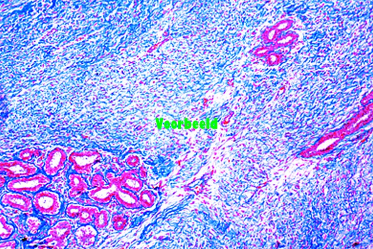 Fibroadenoma intracanaliculare of mamma