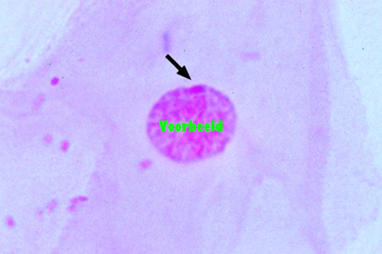 Barr bodies (human sex chromatin) in sme