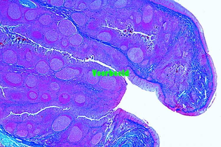 Tonsil, human, t.s.