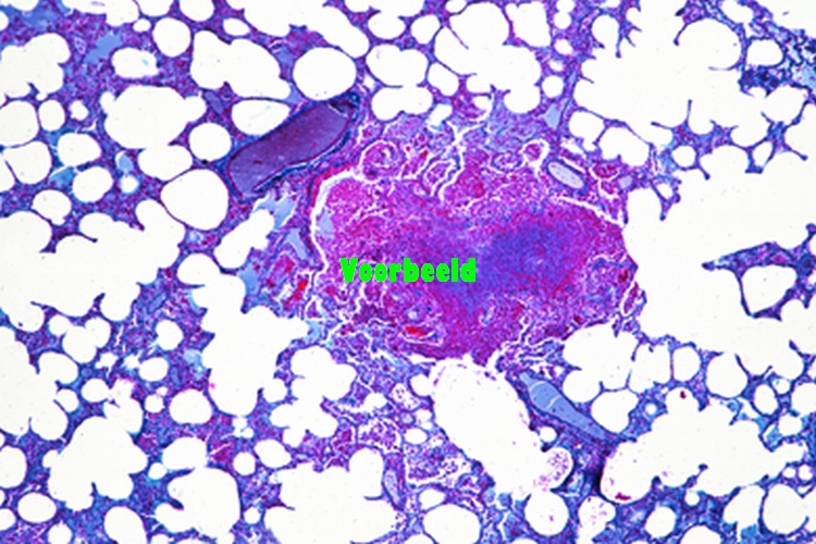 Miliary tuberculosis of lung