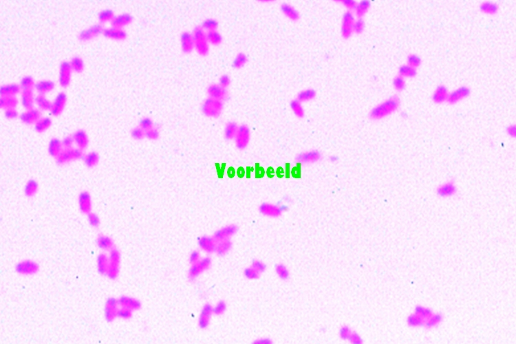 Tuberculose