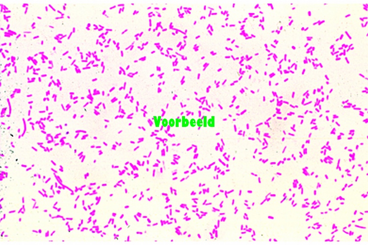 Anthracosis pulmonum