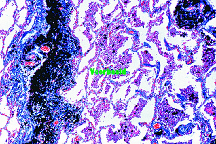 Arteriosclerosis