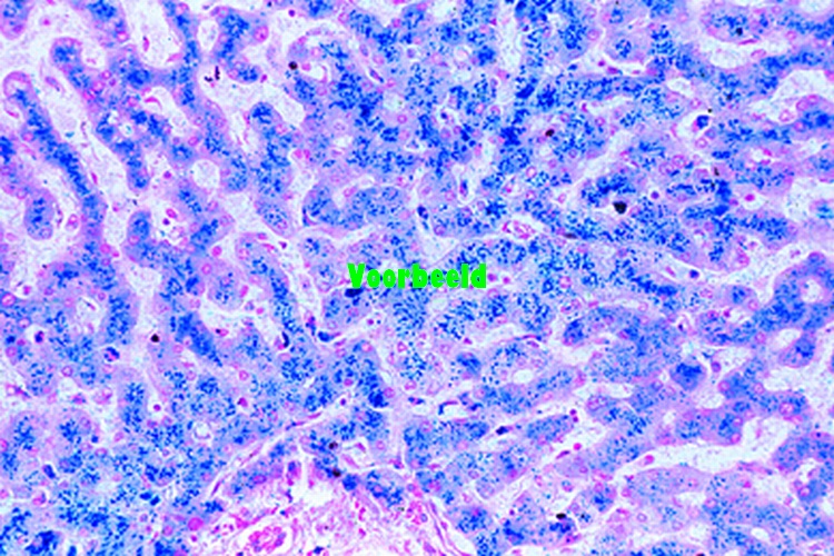 Hemosiderosis of liver