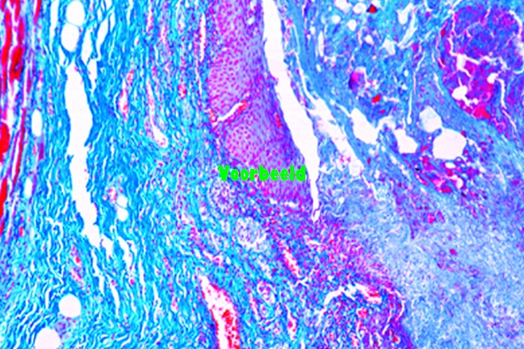 Necrotic esophagitis