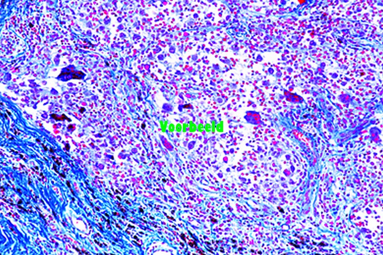Foreign body granulome with hemosiderin