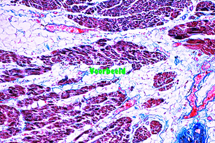 Adiposis of heart