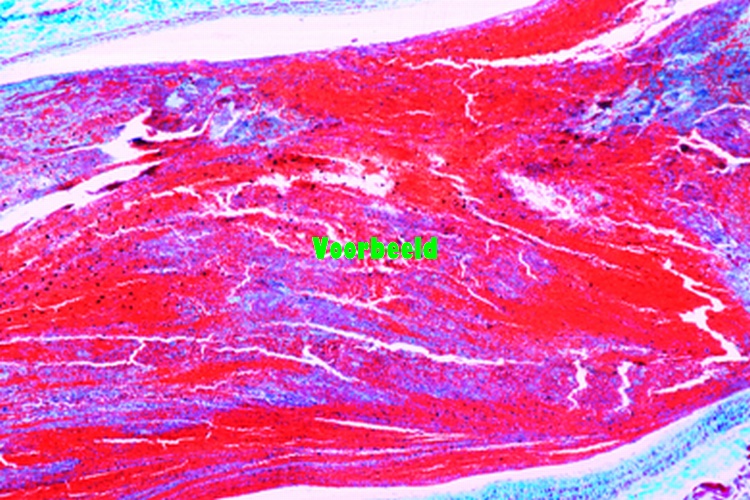 Organized venous thrombosis of muscle