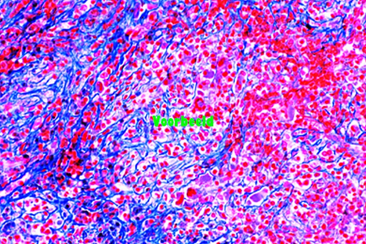 Chronic myeloid leukemia of spleen
