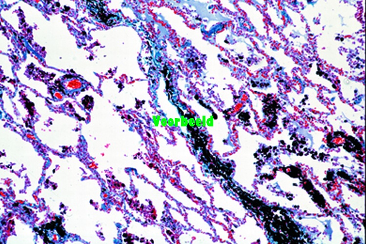 Anthracosis of lung