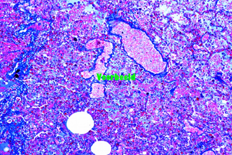 Influenzal pneumonia