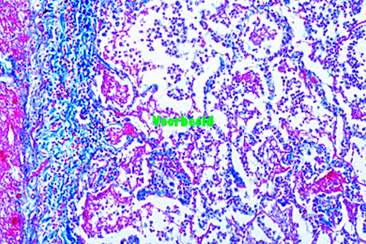 Croupous pneumonia