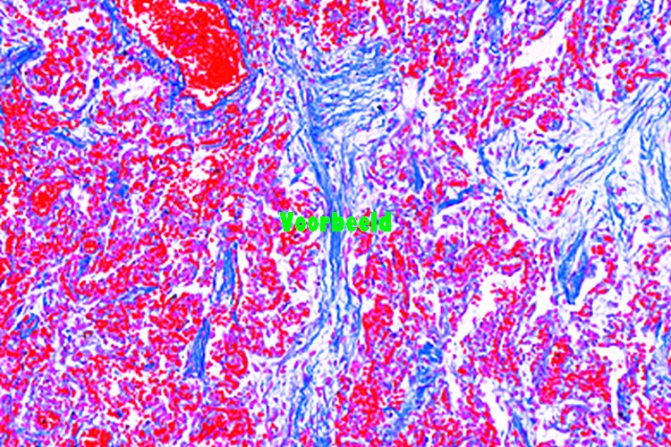Chronic pneumonia