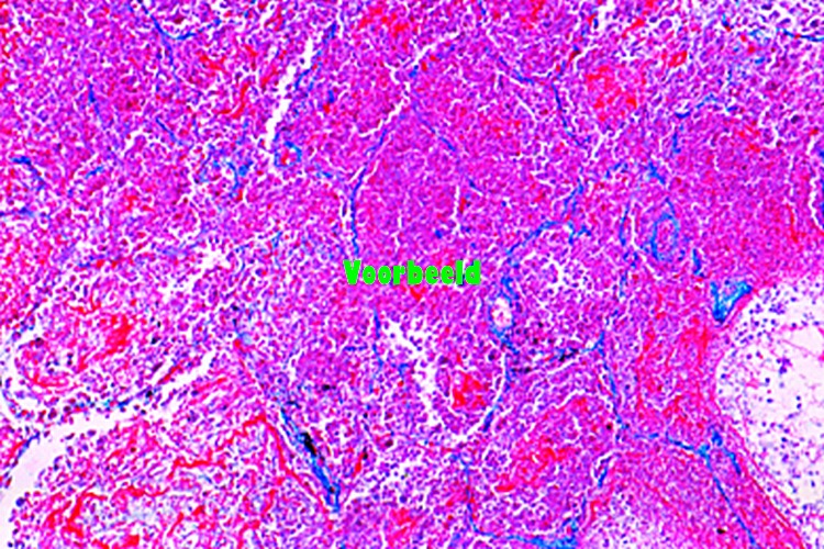 Necrotic (cheesy) pneumonia