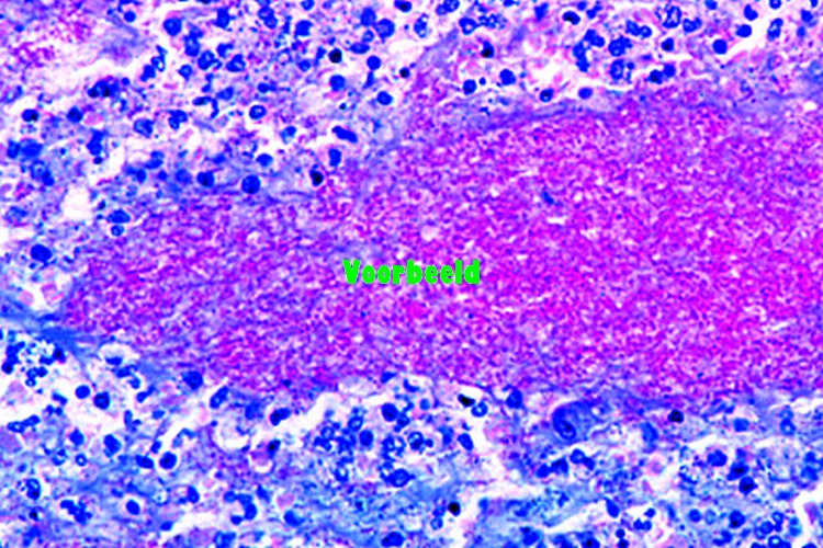 Chronic tuberculous pulmonary cavity wit