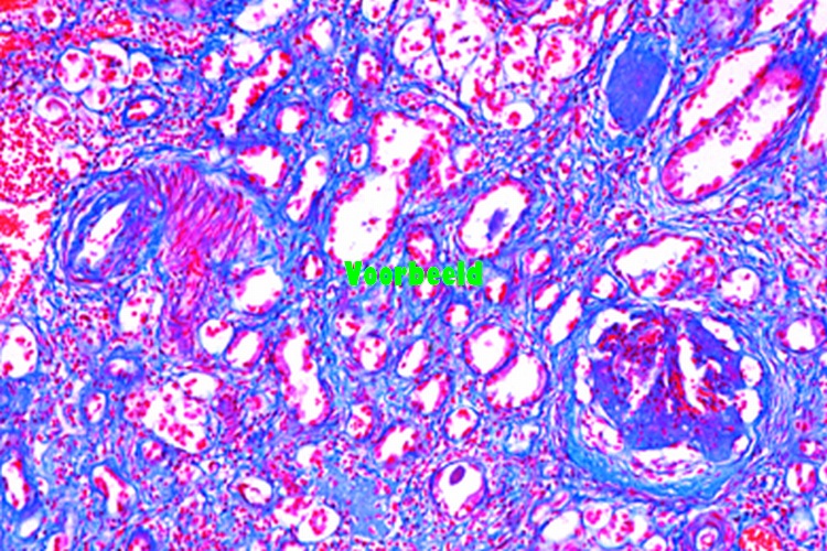 Glomerularathrophy of kidney