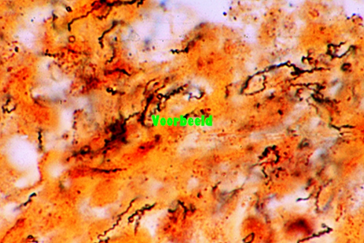 Congenital syphilis of liver, spirochaet