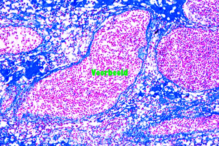 Gumma of testicle