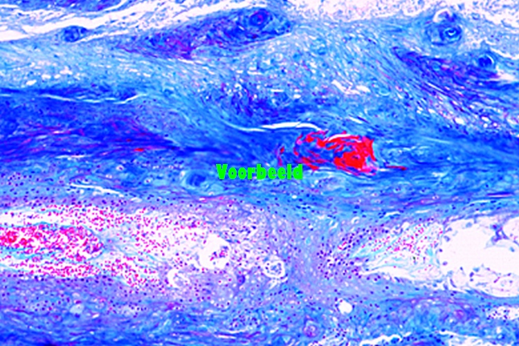 Atheroma of head