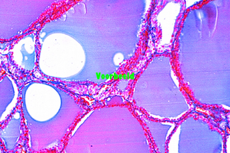 Struma colloides