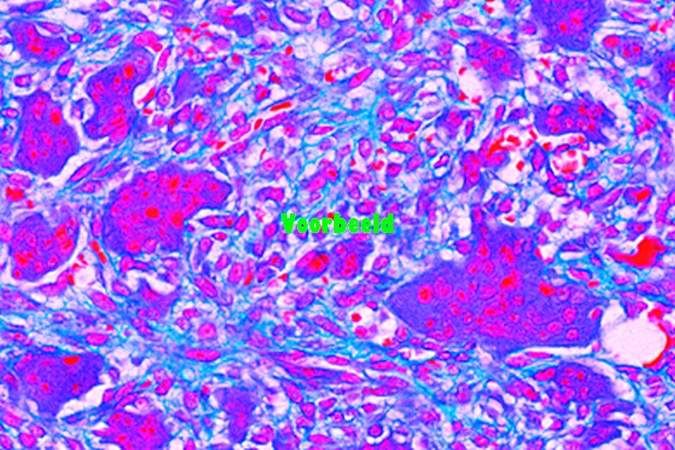 Giant cell sarcoma of maxilla