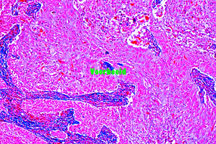 Carcinoma cervicis uteri