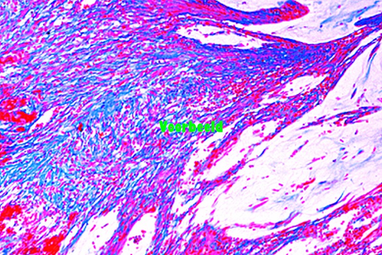 Gelatinous carcinoma of rectum