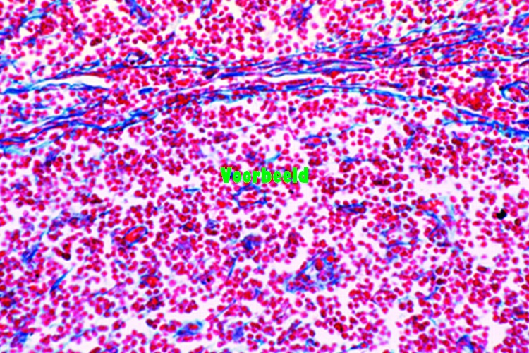 Lymphosarcoma mediastini