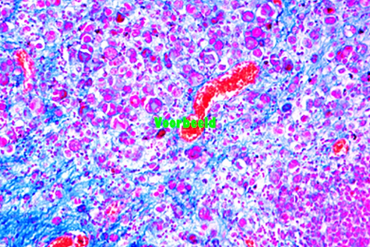 Metastatic carcinoma of liver